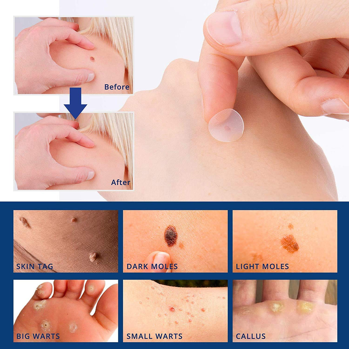 ZORBES® 72 Pcs Invisible Hydrocolloid Pimple Tag Remover for Face Skin,Remove All Skin Type Acne Patches for Women Girls